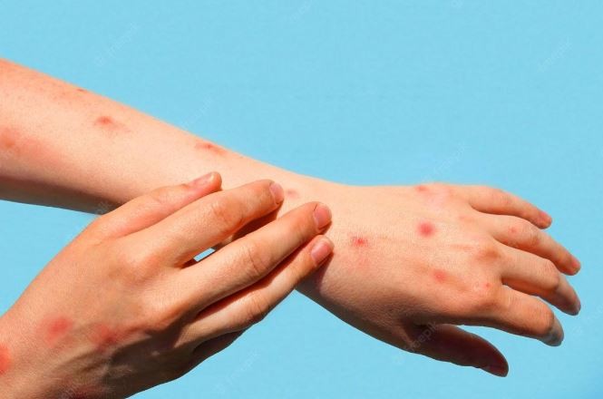 भारतमा टोमाटो फ्लुको सङ्क्रमण बढ्दै : नेपालमा पनि जोखिम