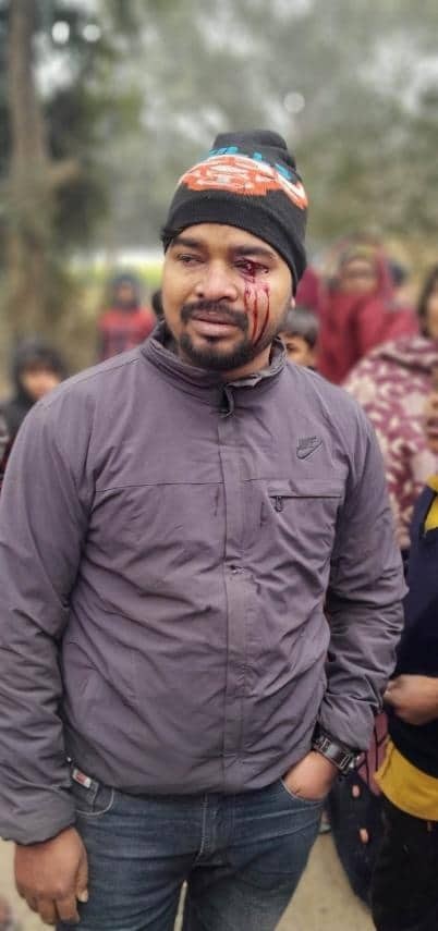 कपिलवस्तुमा प्रधानाध्यपकको कुटाईबाट शिक्षक घाइते